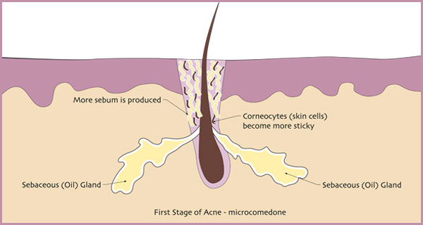 microcomedone.jpg