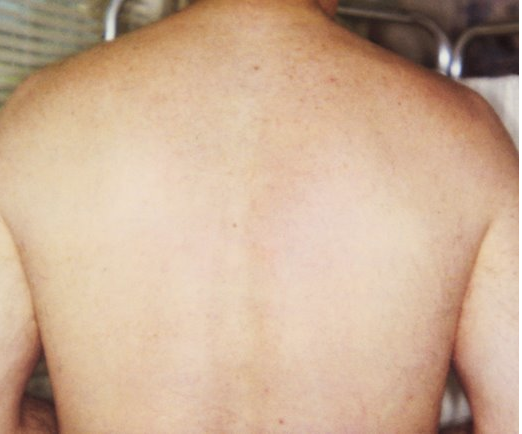Image showing the back following the hair reduction treatment.