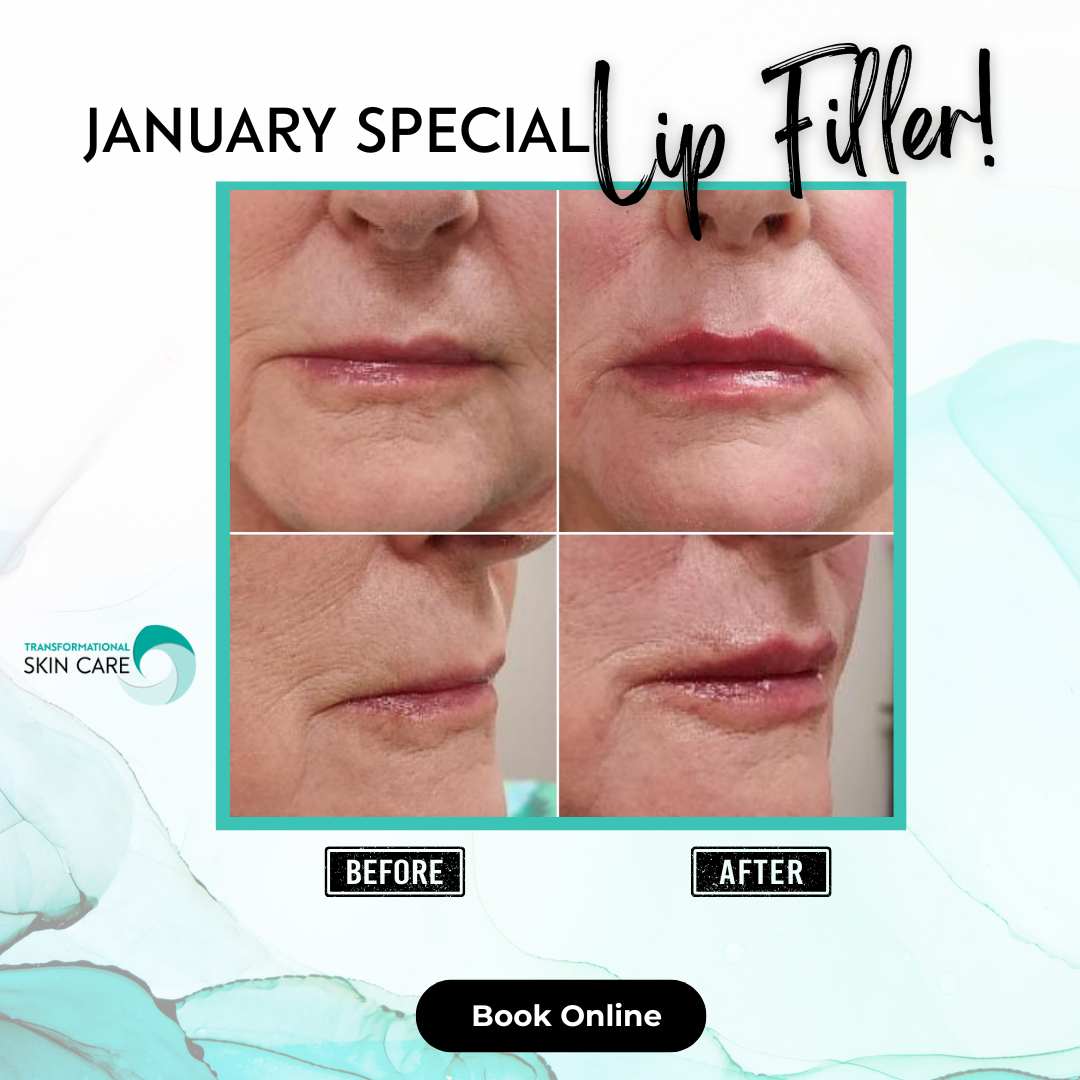 Schedule your appointment for the January Lip Filler Special.